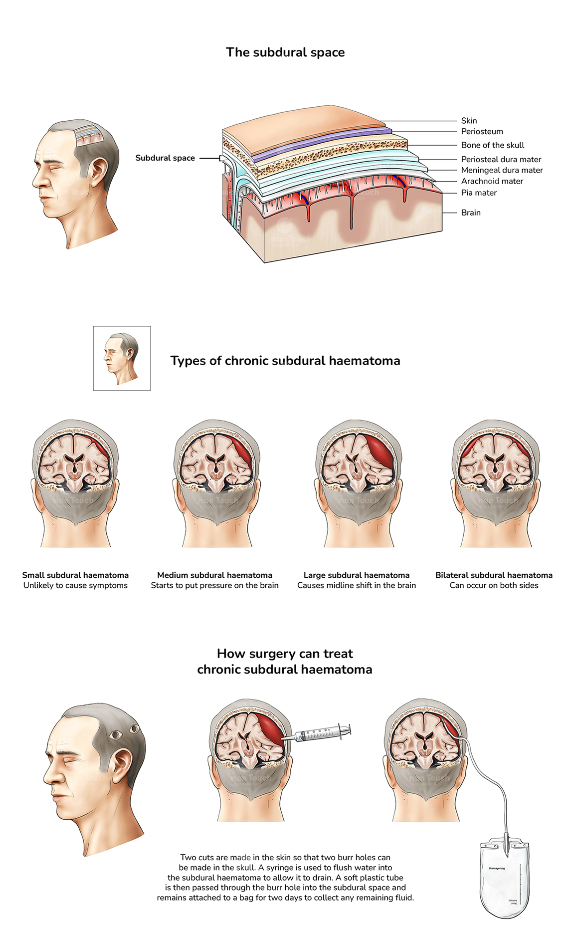 Chronic subdural haematoma